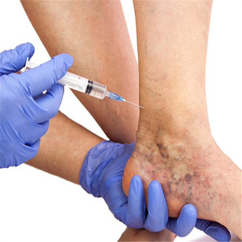 Complaints related to varicose veins